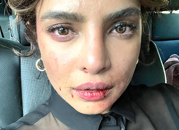 Priyanka Chopra shares a photo with a bruised face; here is how fans reacted to it